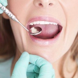Bastano 6 denti per mettere a rischio la salute della bocca