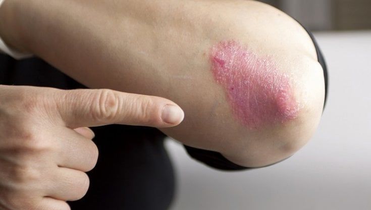 PsoPoint: videoconsulti online per non lasciare soli i pazienti con psoriasi