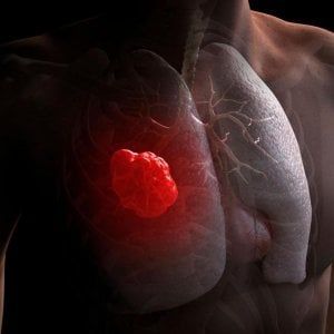 Tumore del polmone, con terapia target in fase precoce rischio di ricaduta si riduce dell’83%