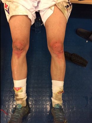 Fiorentina, per Kalinic dieci falli subiti in 90 minuti: la foto delle sue gambe diventa virale