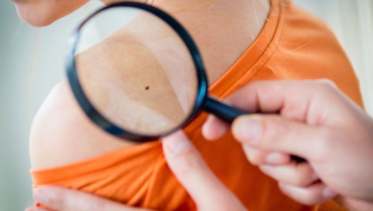 Prevenzione melanoma, un progetto nazionale al Santa Maria Annunziata 