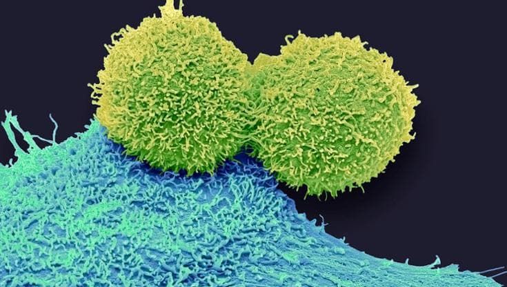Tumore al seno, così la viscosità influenza la capacità delle cellule di diffondersi