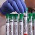 Hantavirus: negativi i test dei casi sospetti in Italia. Francia, allarme per Norovirus su una nave