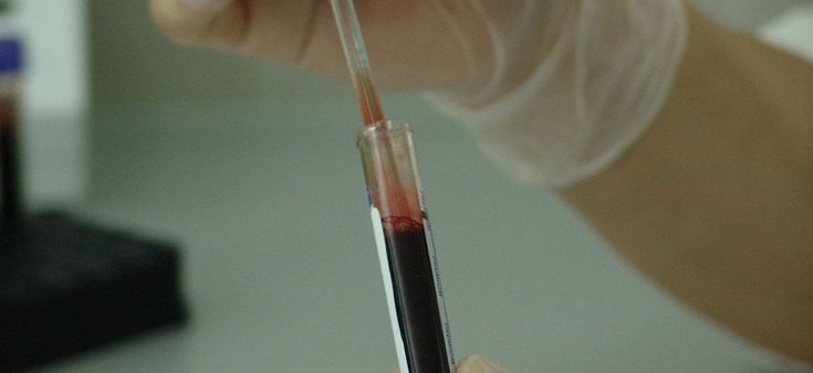 Biopsia liquida, nuovo test super-sensibile per il tumore al seno