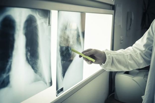 Tumori femminili, geni Brca1 e Brca2 mutati: il test fa prevenzione, ma in Italia costa troppo