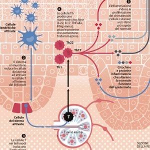 Psoriasi, i linfociti impazziti che scheggiano la pelle 