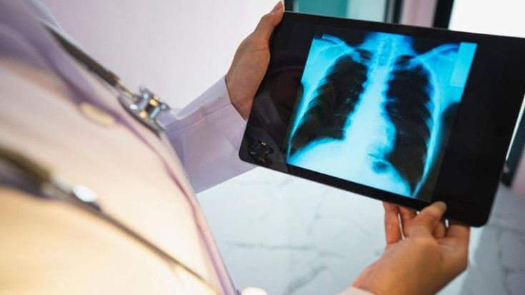 Polmonite interstiziale: “Può essere causata dai virus di stagione. Fa calare l’ossigeno nel sangue”