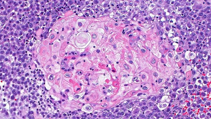 Tumore alla vescica operabile, arriva una nuova opzione terapeutica
