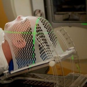 Metastasi cerebrali: la radioterapia totale non migliora la sopravvivenza né la qualità della vita
