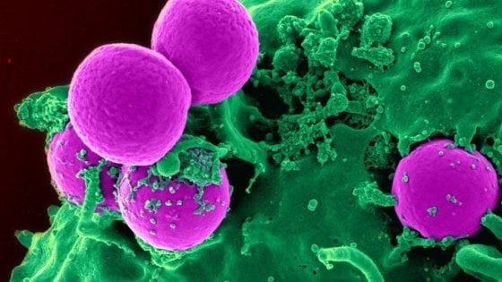 Così le cellule del cancro sono “scortate” dai globuli bianchi