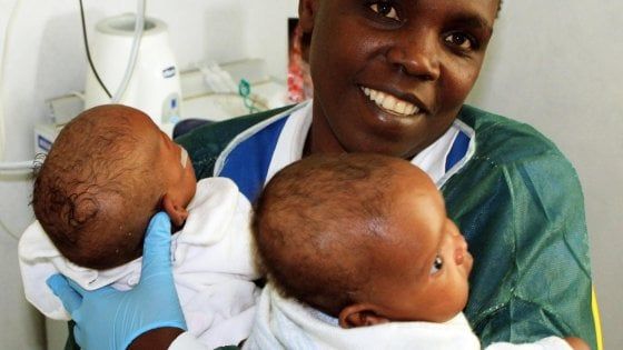 Separate al Bambino Gesù di Roma gemelle siamesi arrivate dal Burundi