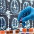 Neurologia, la rivoluzione dei biomarcatori: così si scoprono le malattie prima dei sintomi