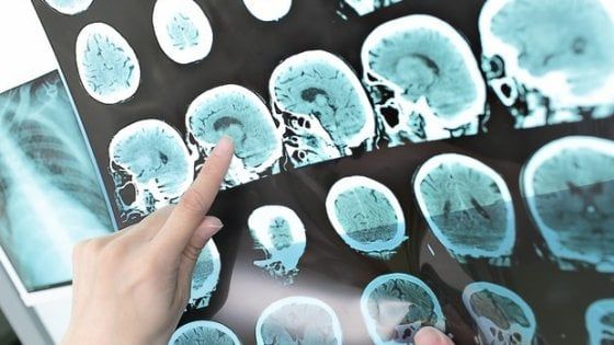 Alzheimer, la diagnosi arriva dall'intelligenza artificiale