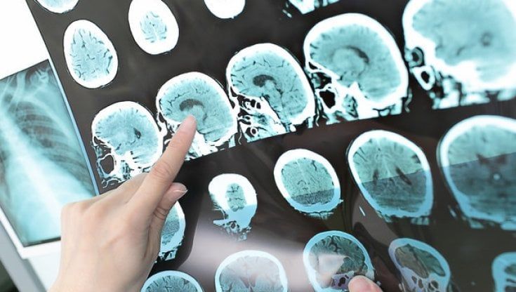 Dopo un intervento vascolare un cerotto può prevenire il rischio di ictus 