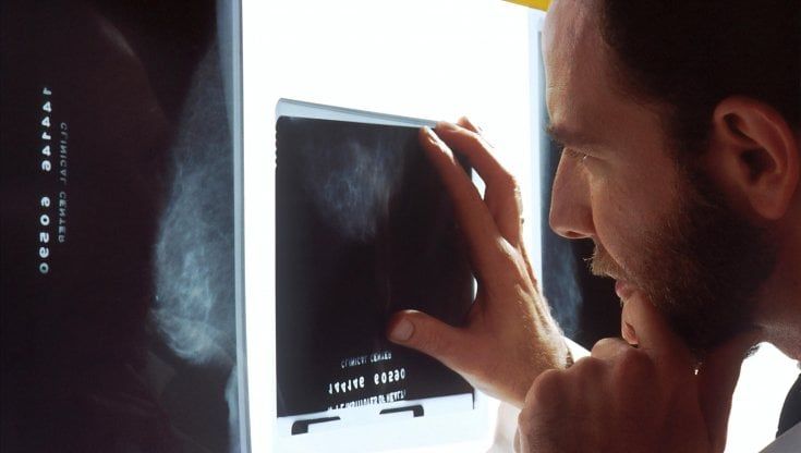 Tumore al seno, lo screening con la mammografia funziona sempre